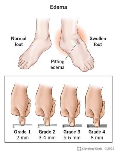 Edema is a condition caused by excess fluid in the body's tissues.