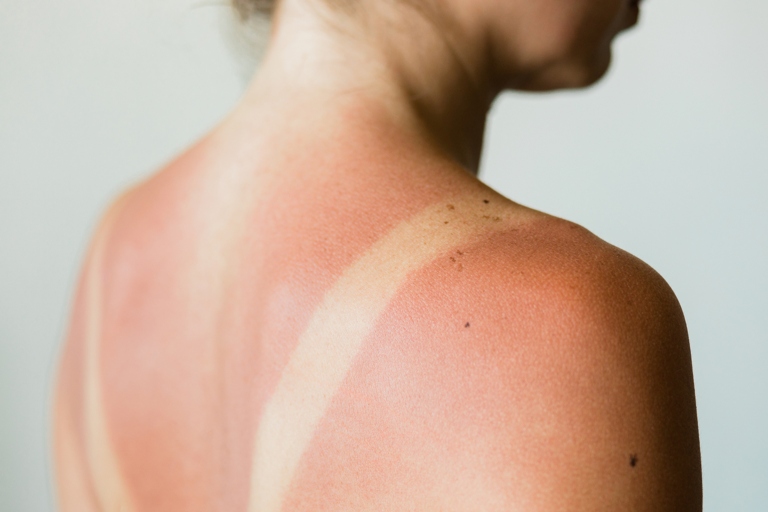 If you find yourself with a sunburn after a day in the sun, don't worry, there are a few things you can do to ease the pain.